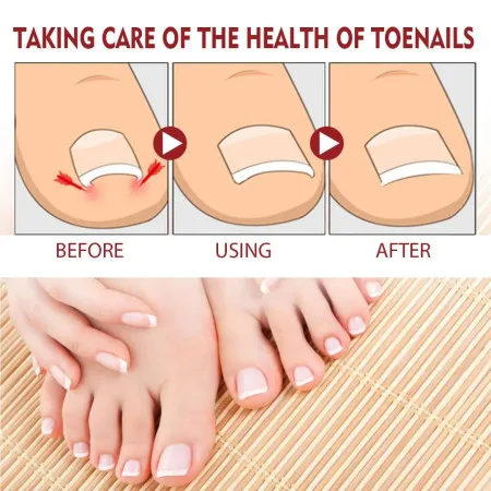 Anti Paronychia Relief Oil - thumb 3