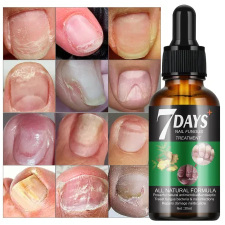 7 DAYS Nail Fungus Treatment Liquid - thumb 2