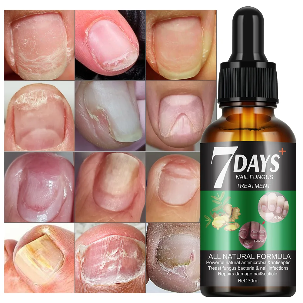 7 DAYS Nail Fungus Treatment Liquid - thumb 9