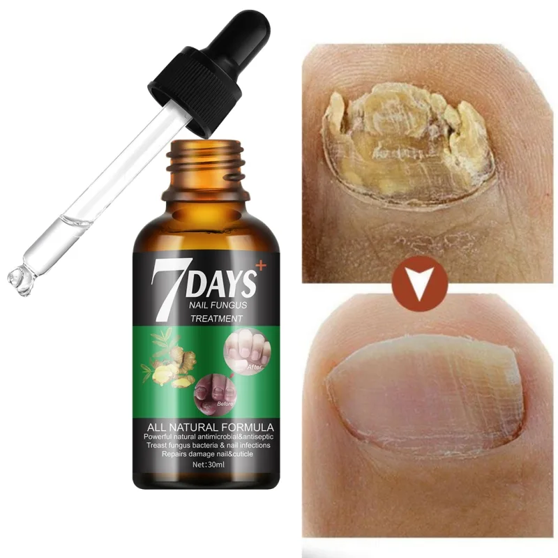 7 DAYS Nail Fungus Treatment Liquid - thumb 11