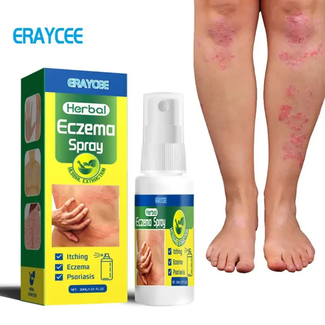 Eraycee Herbal Eczema Spray - thumb 2